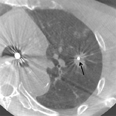 Computed Tomography Guided Transbronchial Lung Biopsy With Biopsy