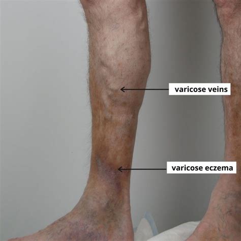Is Varicose Eczema Serious The Veincare Centre