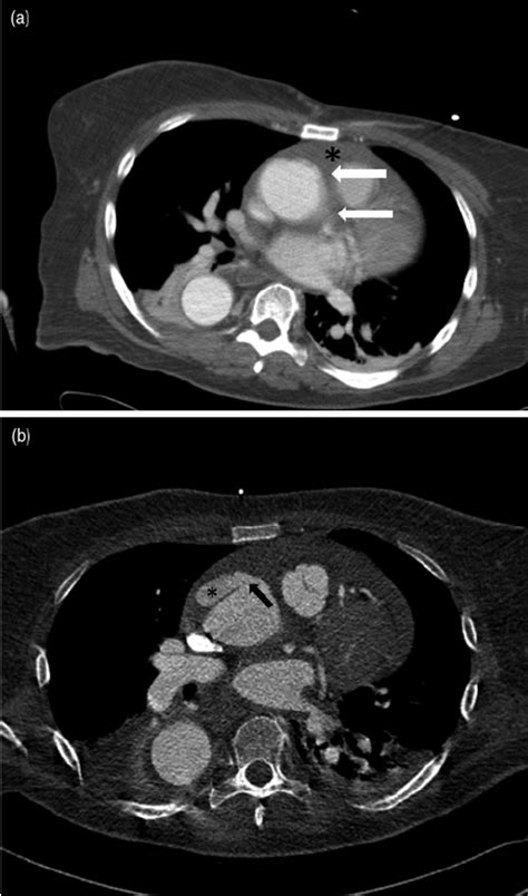 Chest Ct Of Ascending Aorta A Chest Ct At The Level Of The Aortic