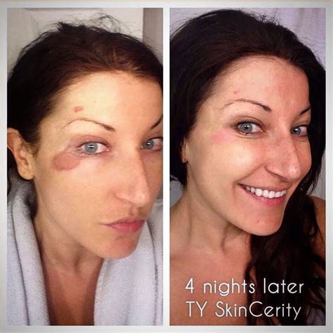 Skincerity Before And After Wow To Get Your Bottle Check Out My