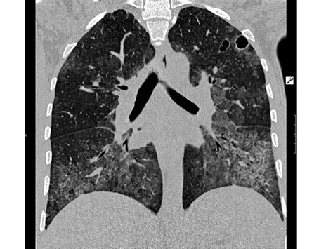 Pcp Pneumocystis Jirovecii Pneumonia Image