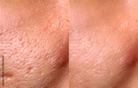 Fotka „comparison Of Skin Before And After Laser Resurfacing Skin With
