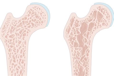 Trabecular Bone Score Plus Bmd Improves Identification Of Abnormal Bone