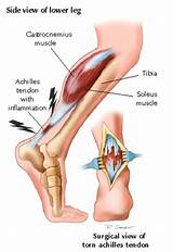 Medical Treatment For Tendonitis Photos