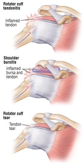 Rotator Cuff Injury Differential Diagnosis Of Thoracic Outlet Syndrome
