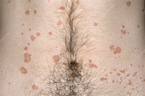 Acute Guttate Psoriasis Stock Image M2400771 Science Photo Library