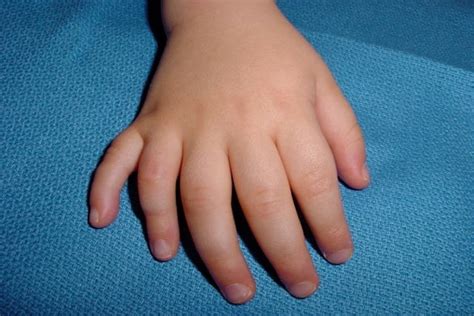 Polydactyly Observation Hand Surgery Resource