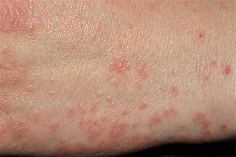 What Is Scabies Medguidance