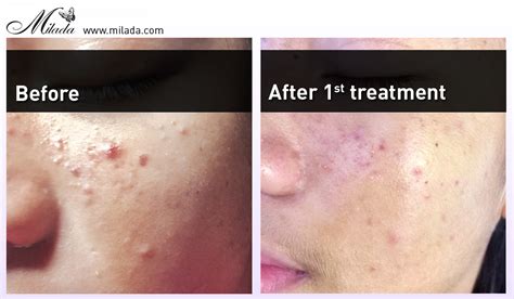 An ipl treatment uses the power of broadband light to improve the appearance of sun spots, rosacea, age spots, and skin texture. BEFORE-AFTER-Anti-Acne-Treatment-with-IPL-Laser-Montreal ...