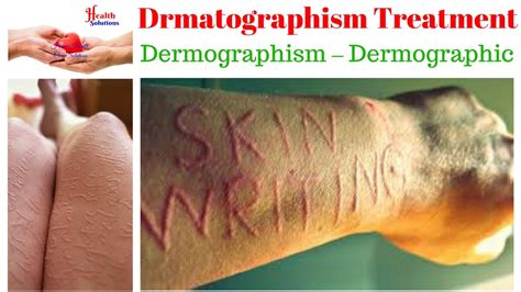 Drmatographism Treatment Dermographism Dermographic Youtube