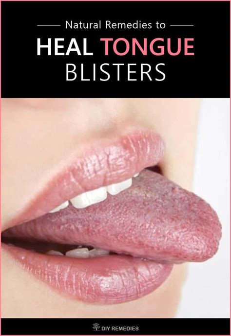 Natural Remedies To Heal Tongue Blisters