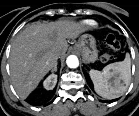 Splenic Hamartoma Spleen Case Studies Ctisus Ct Scanning