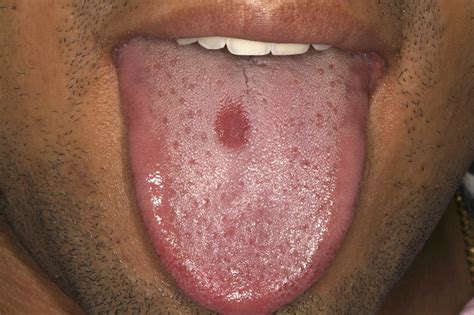 Tongue Papillae Atrophy