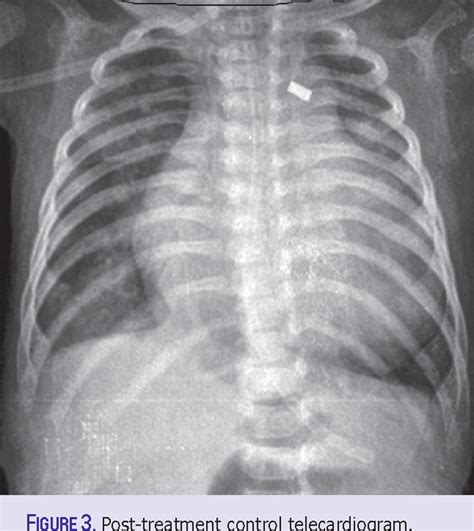 Pdf Treatment Of Chylothorax Developed After Congenital Heart Disease