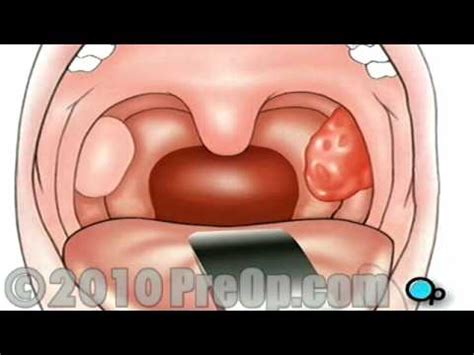 Tonsillectomy Surgery Preop Patient Education Feature Youtube