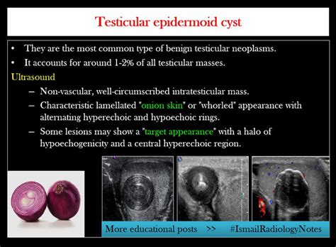 Testicular Epidermoid Cyst