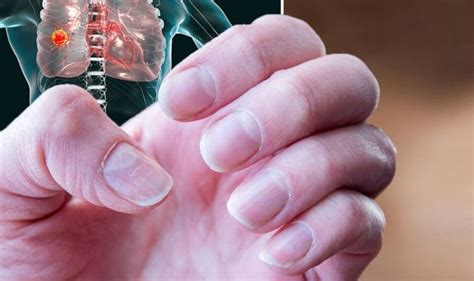 Lung Cancer Symptoms Your Fingertips Are A Warning A Sign