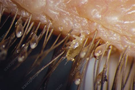 Lice On Eyelashes Stock Image M Science Photo Library