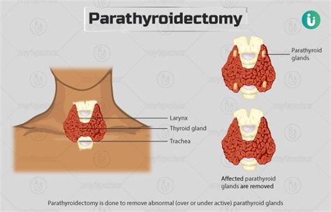 Parathyroidectomy Procedure Purpose Results Cost Price