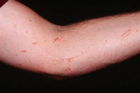 Can Poison Ivy Cause Water Retention