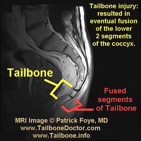 Tailbone Injury Pain Fracture Mri Fused Coccyx Foye Flickr Photo