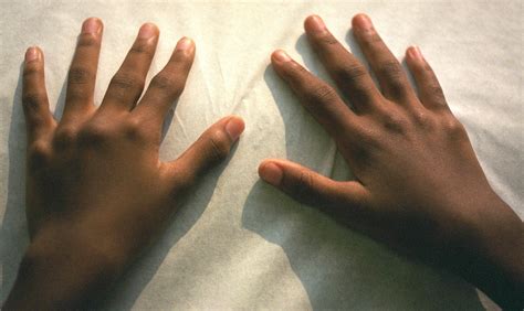 The hallmark feature of this condition is persistent symmetric polyarthritis (synovitis) rheumatoid arthritis disease activity measures: Biomarker bei rheumatoider Arthritis