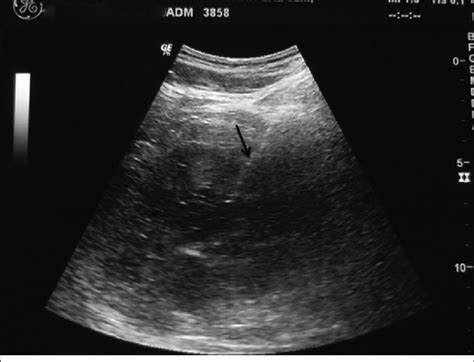 Ultrasound Guided Biopsy From The Renal Parenchyma The Renal Cortex Is