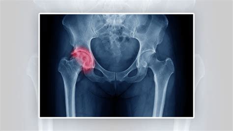 Best Hip Replacement Surgeon In Hyderabad Hip Replacement Surgery