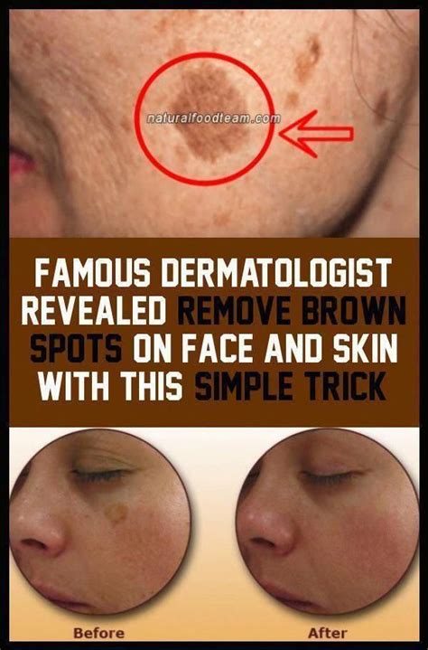 Remove Brown Spots On The Face And Skin With This Simple Trick Smallbrownspotsonskin