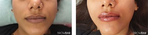 What Is Lip Discoloration Correction Browbar