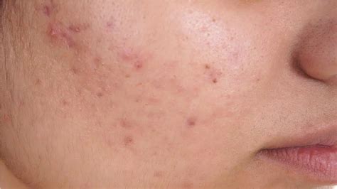 How To Get Rid Of Fungal Acne Unlike Acne Fungal Acne Appear In