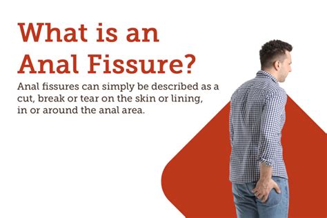 Fissure Causes Symptoms Treatments And More