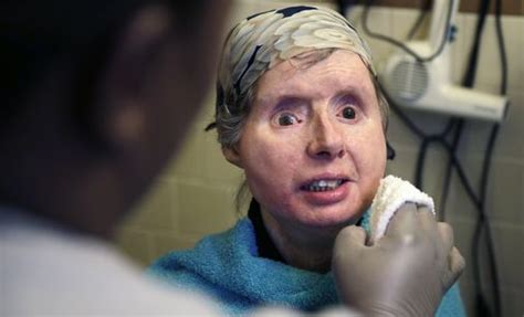 Chimp Victim Who Underwent Face Transplant Back In Boston Hospital The Boston Globe