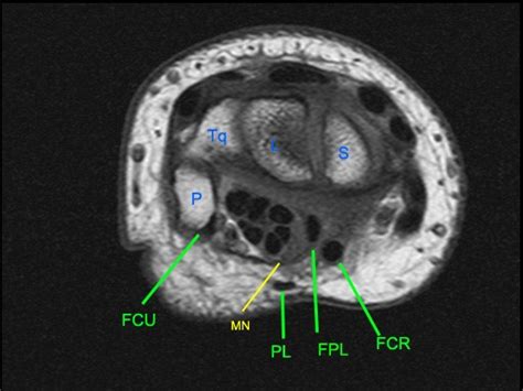 Flexor Carpi Radialis Tendinopathy - Radsource