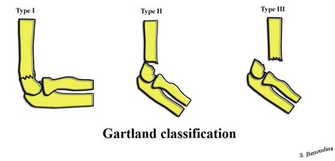 Gartland Classification Wikidoc