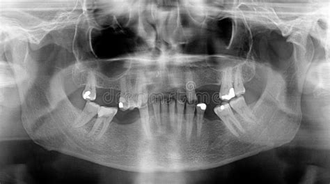 Panoramic Dental X Rays Stock Image Image Of Xray Anatomy 28151625