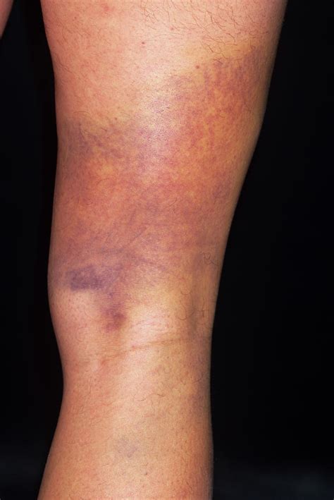 Bruised Thigh Photograph By Dr P Marazzi Science Photo Library