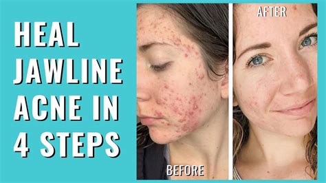 Jawline Acne Clear Cystic Acne On Jawline Fast Youtube