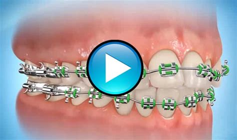 Patient Care Videos Stoneham Malden Ma Chase Orthodontics