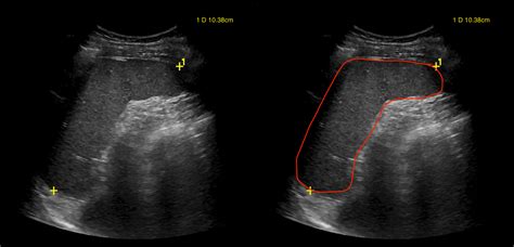 Protocoling Imaging Studies Complete Abdominal Ultrasound Ultrasound