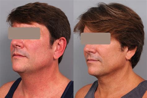 Smartlipo Neck Liposuction And Ipl Photofacial In New York