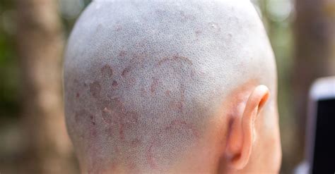 Saçkıran Nedir, Neden Olur ve Nasıl Geçer? Saçkıran Belirtileri