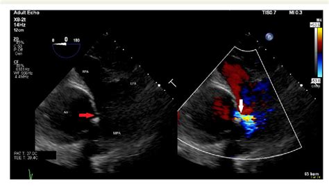 Figure From Acquired Aortopulmonary Fistula A Case Report My XXX Hot Girl