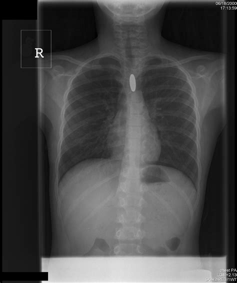 Child With Esophageal Coin And Atypical Radiograph Journal Of