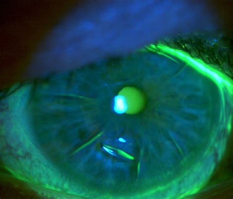 Fitting Scleral Lenses On Patients With Radial Keratotomy