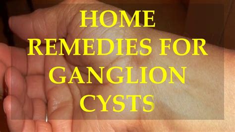 Home Remedies For Ganglion Cysts Youtube