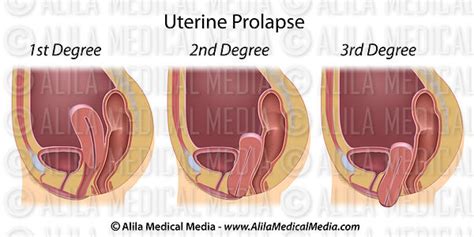 rectal prolapse signs rectal prolapse symptoms causes treatment surgery