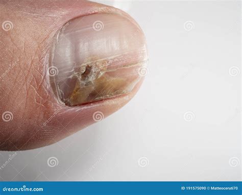 Nail Infections Caused By Fungi Such As Onychomycosis Also Known As