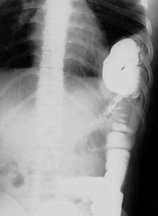 Diaphragmatic Hernia Radiology Reference Article Radiopaedia Org