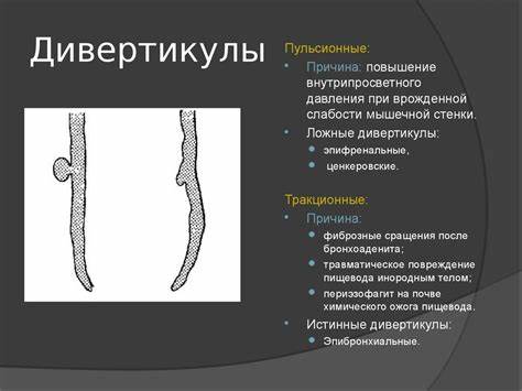 Заболевания пищевода. Смещения пищевода. Дивертикулы. Инородные тела Картинка - Заболевания пищевода. Смещения пищевода. Дивертикулы. Инородные тела
